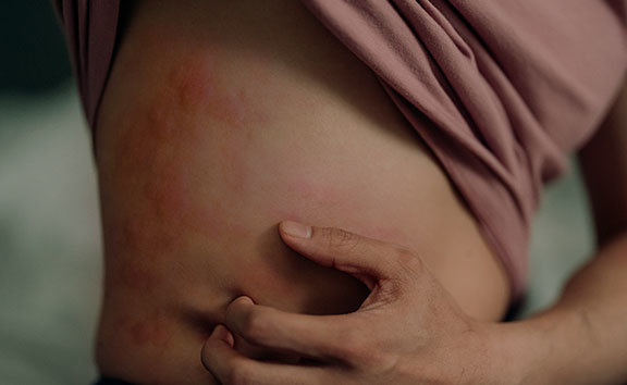 Woman scratching hives on her torso