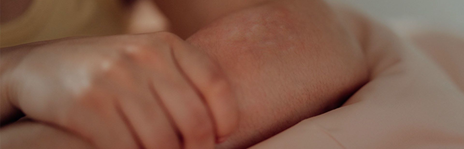 Close-up of chronic hives on arm