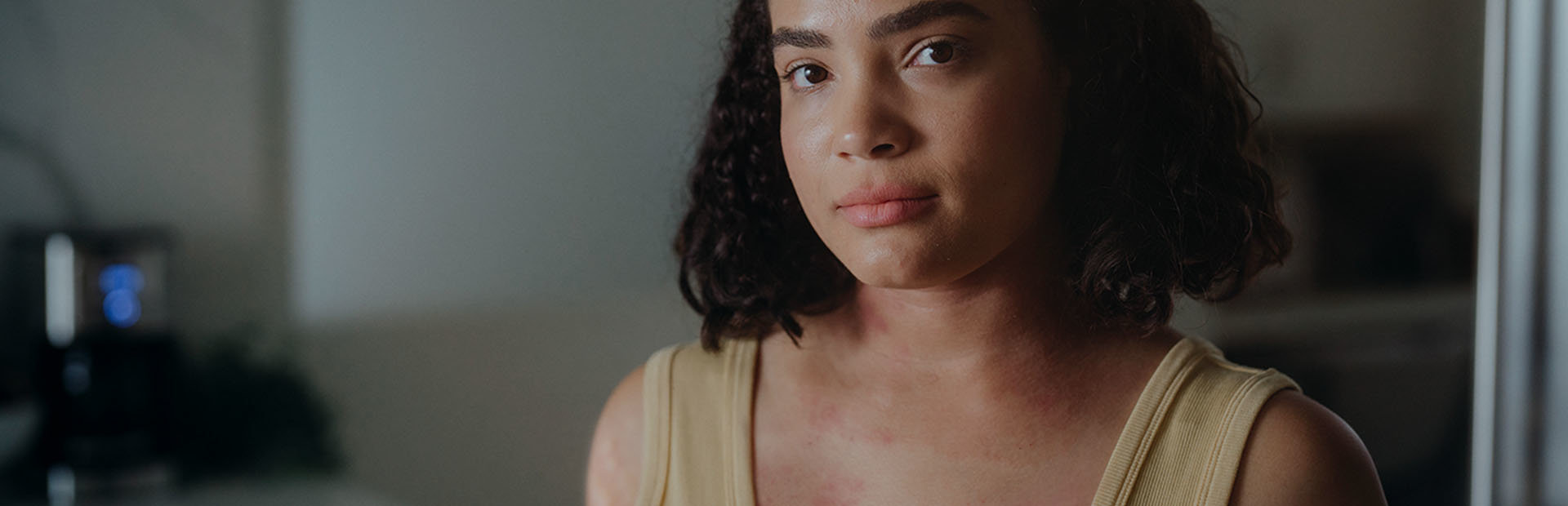 Young woman with hives looking straight ahead