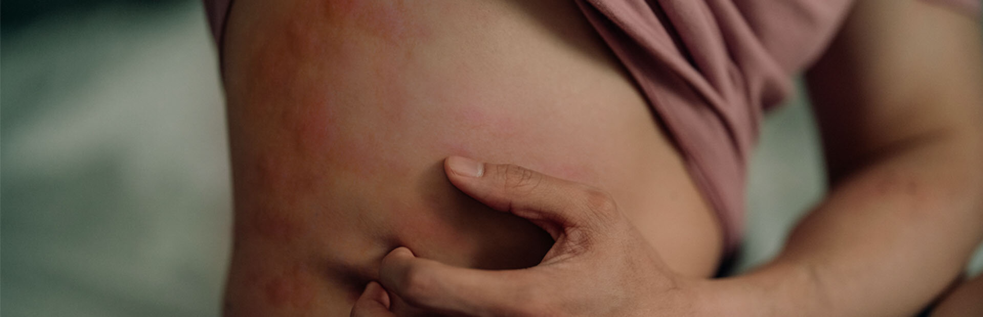 Woman scratching hives on her torso.